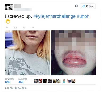 Aussehen wie Kylie Jenner - kann auch nach hinten losgehen